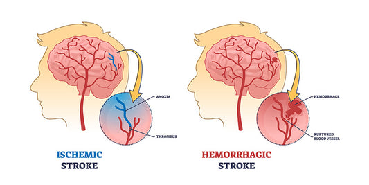 Stroke and Transient Ischaemic attacks (TIAs)