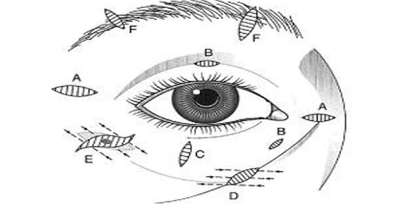 Periorbital defects