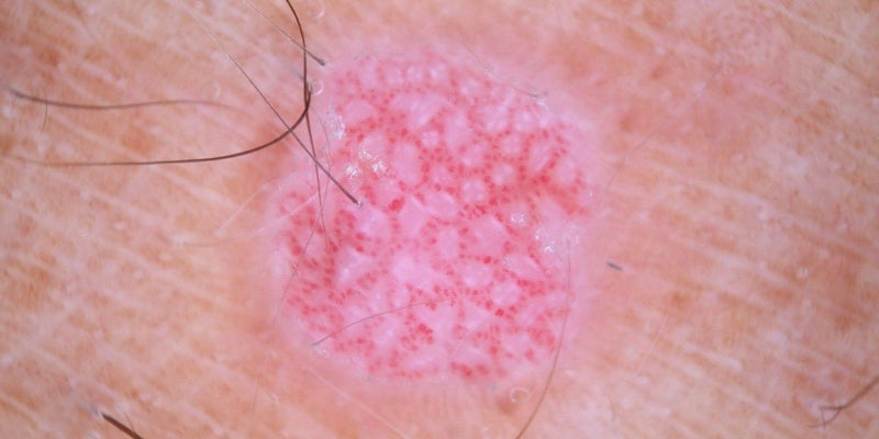Dermoscopy for pink lesions
