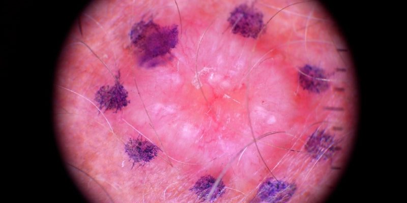 Suturing and Perfecting the Ellipse