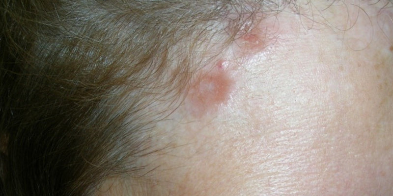 Treatment of dermatomyositis and sarcoidosis