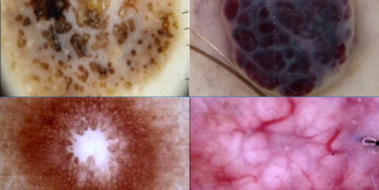 Non-melanocytic lesions Part 1