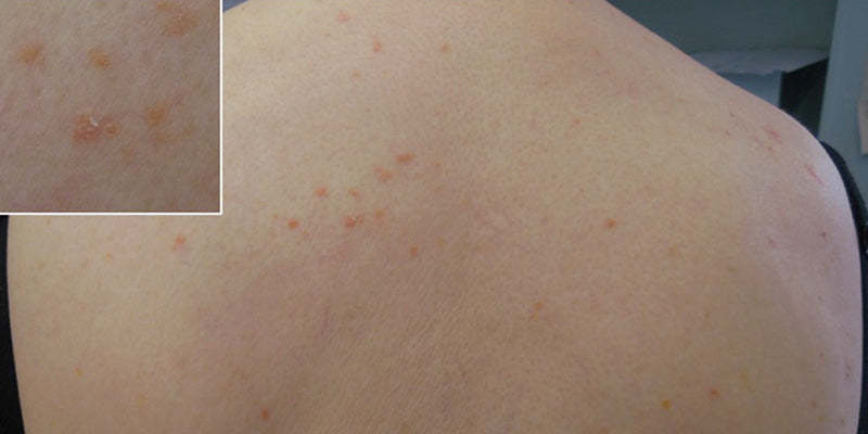 Disorders of pigmentation, infiltrative dermatoses and uncommon skin diseases