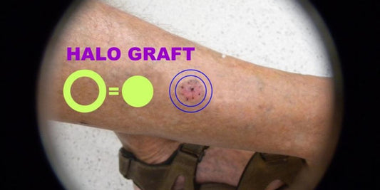 Biopsy, Haemostasis and Halo grafting for skin cancer medicine