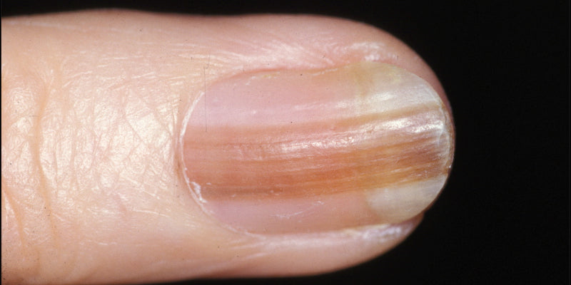 Dermoscopy for nail lesions