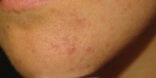 Atopic dermatitis and Acne 2