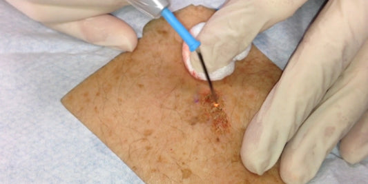 Currettage and Cautery for skin cancer medicine