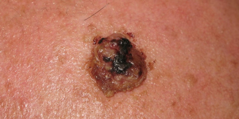 Dermoscopy for rare skin tumours