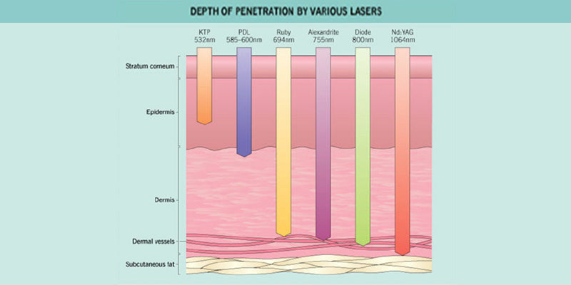 Lasers: Vascular conditions