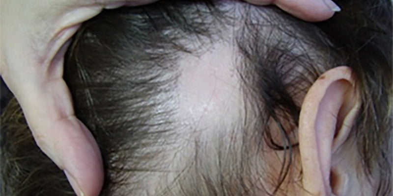 Trichoscopy of common alopecias