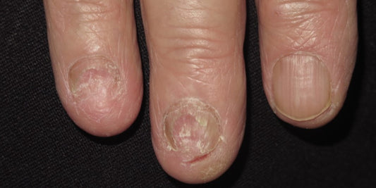 Rare nail disorders and Cicatricial alopecia