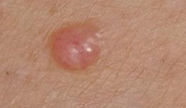 Difficult to diagnose melanomas Outcome Improvement Activity