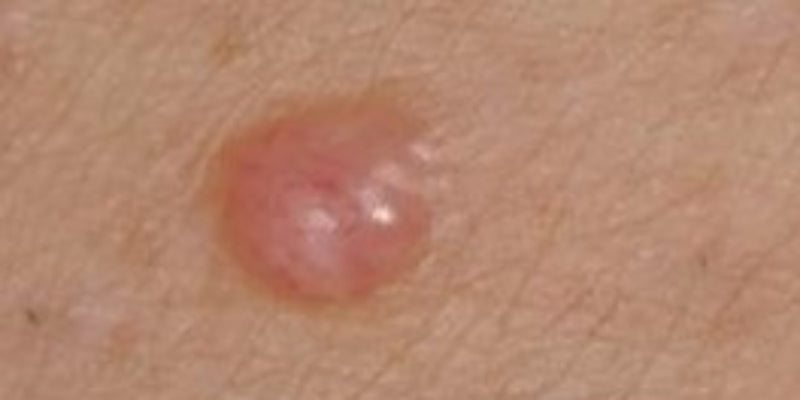 Dermoscopy for difficult melanomas