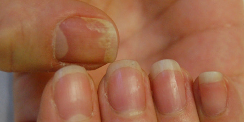 Dermatoscopy of inflammatory and infectious diseases of the nails