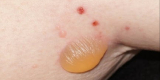 Hidradenitis suppurativa and Bullous pemphigoid