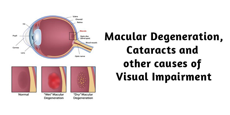 Macular Degeneration , Cataracts and other causes of visual impairment