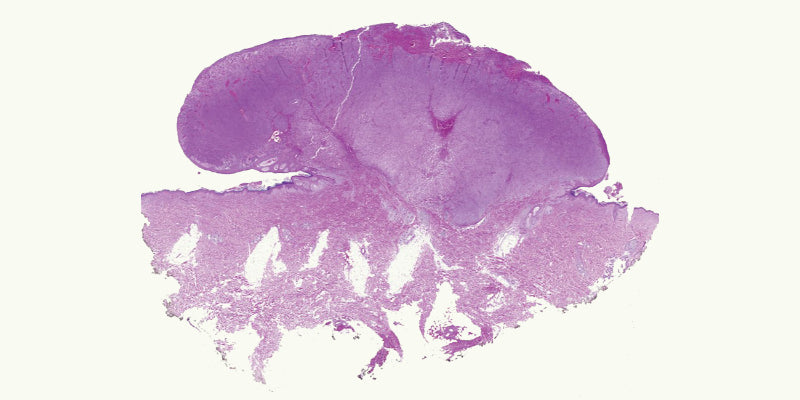 Histopahology fo melanocytic lesions Part 2