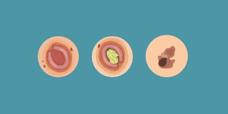 The Big Three: BCC, SCC and Melanoma