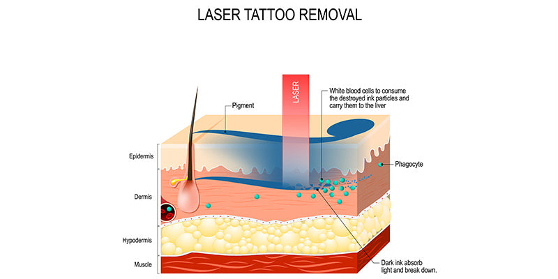 Lasers: Tattoo and Hair Removal