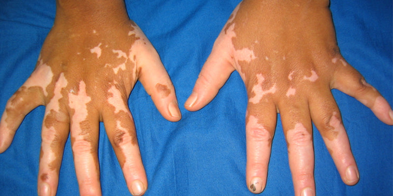 Dermatoscopy in skin of colour