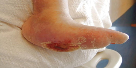 Skin ulcers, pressure sores and wound care