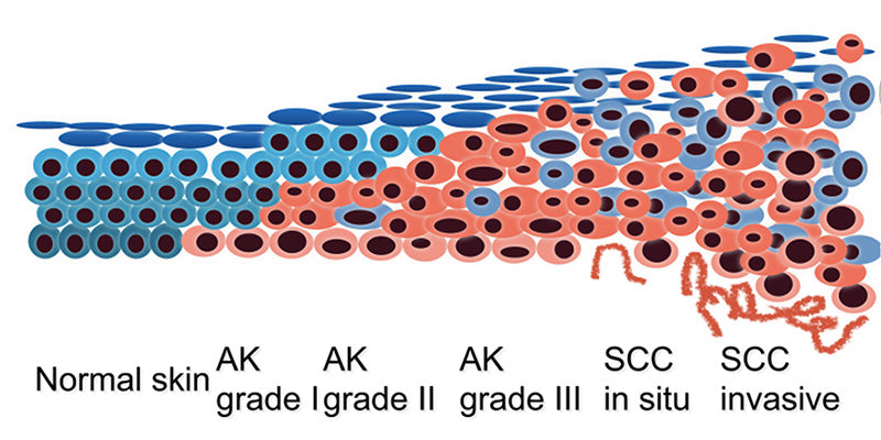 Field treatments for skin cancer medicine