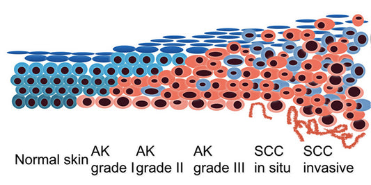 Field treatments for skin cancer medicine