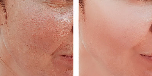 Laser use: Pigment melasma and resurfacing