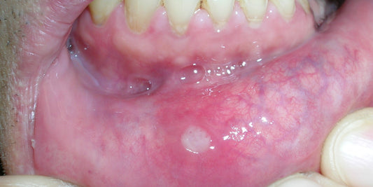 Oral mucosal diseases