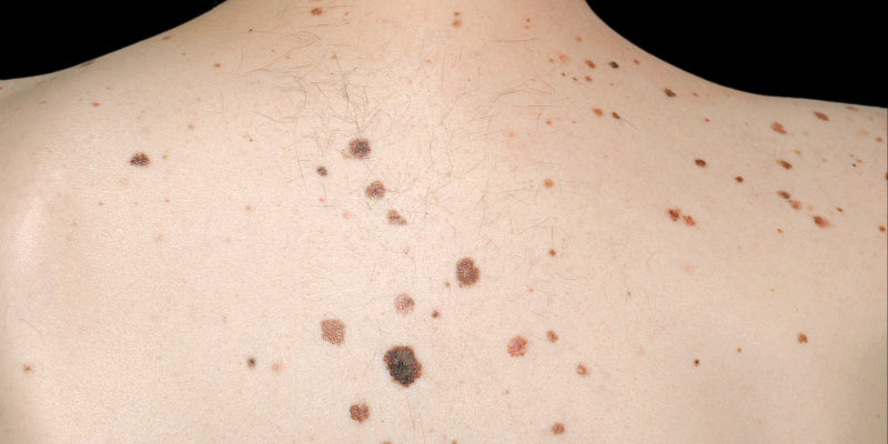 Management of patients with multiple moles