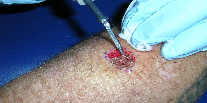 Cryosurgery and electrosurgery in skin cancer medicine