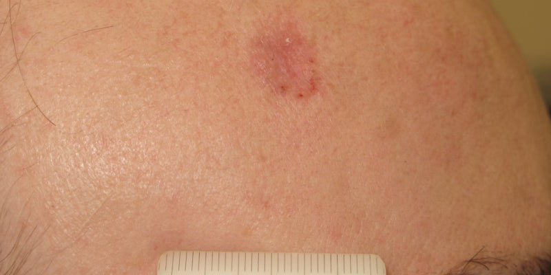 Dermoscopy for the management of non-melanoma skin cancer (NMSC)