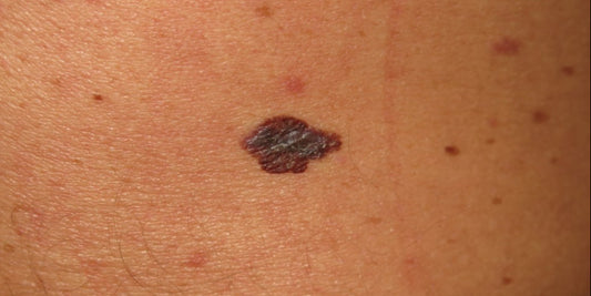 Management rules to detect melanoma