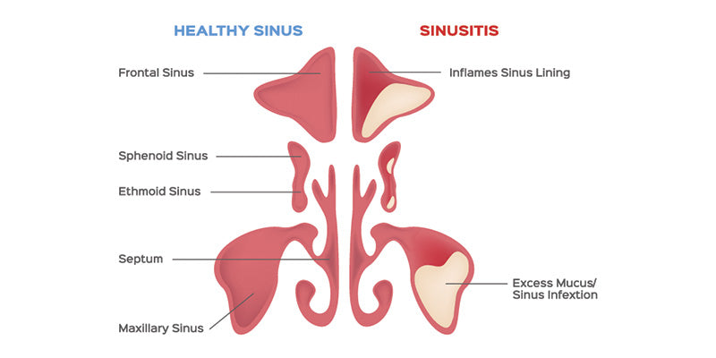 Sinusitis