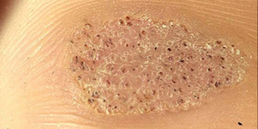 Common benign lesions, pigmentary conditions and cutaneous infections