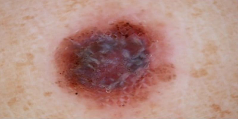 An approach to pigmented skin lesions