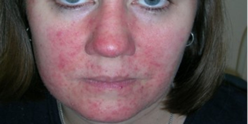 Facial rashes, Systematic diseases and Fungal infections