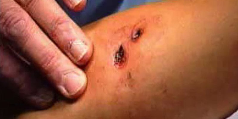 Lacerations and Wounds