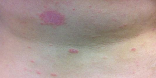 Papulosquamous disorders: Psoriasis, lichen planus and pityriasis rosea