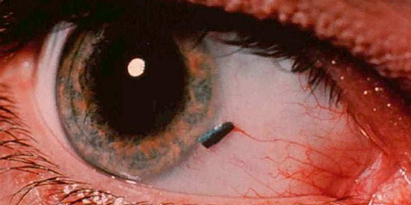 Foreign Bodies and Healing by Second Intention