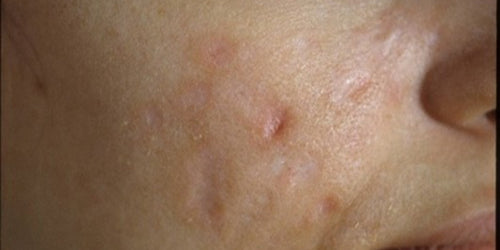 Acne Outcome Improvement Activity