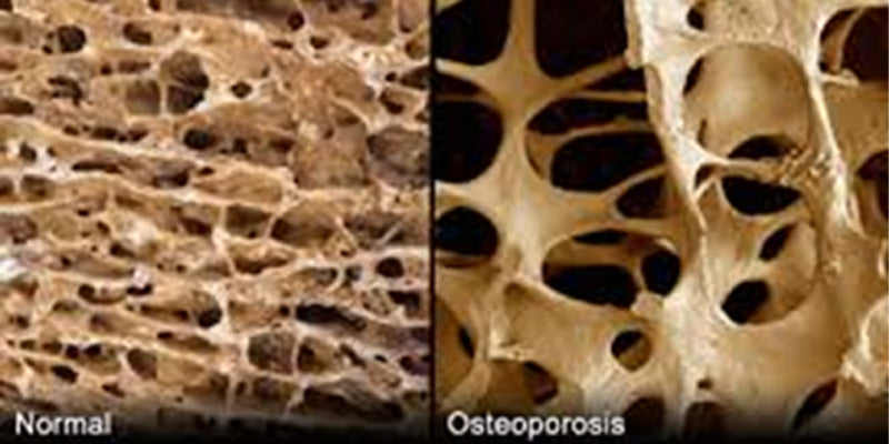 Osteoporosis Outcome Improvement Activity