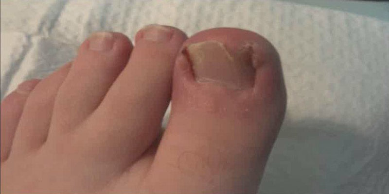Ingrown Toenails
