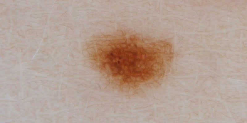 Dermoscopy for melanocytic nevi