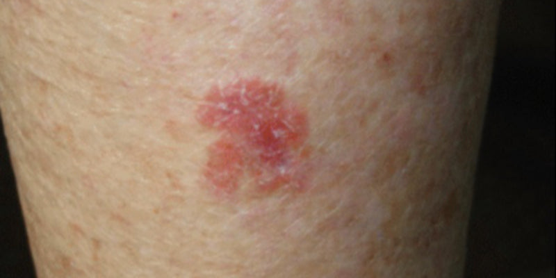 Topical treatment and medico-legal issues for skin cancer medicine
