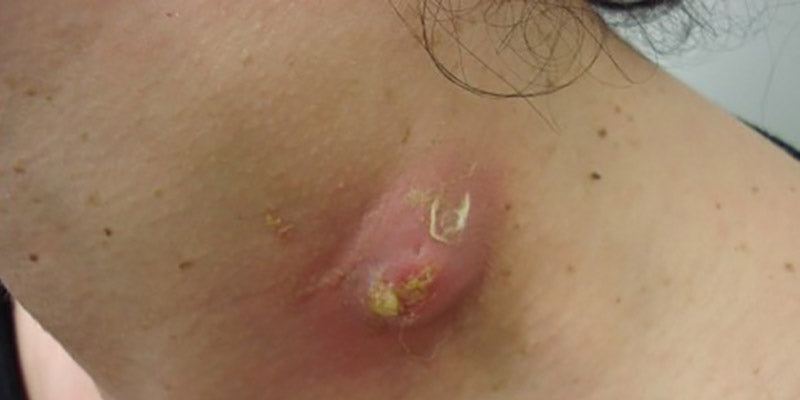 Lumps and Bumps – HealthCert Education