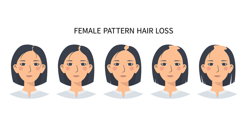 Female pattern hair loss - diagnosis and treatment