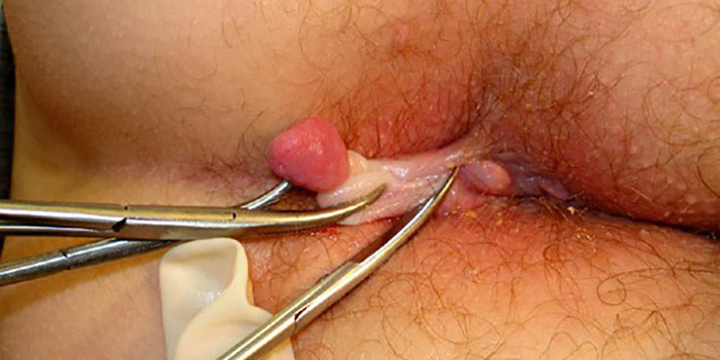 How a specialist manages anal rectal conditions