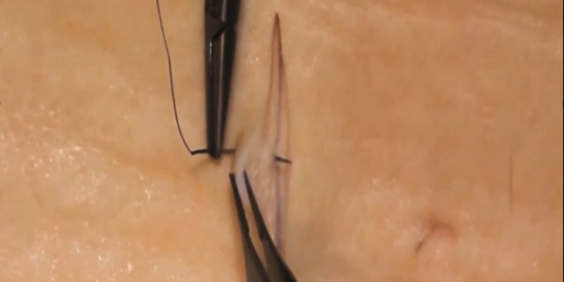 Excision and repair for skin cancer medicine