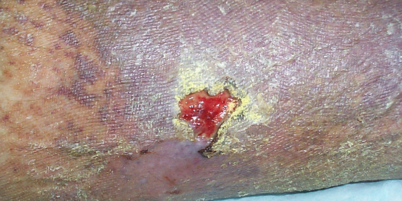 Infected Lesions Outcome Improvement Activity